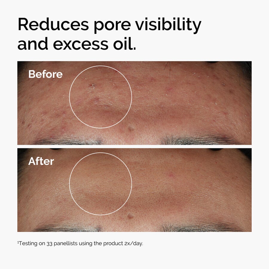 niacinamide-10-zinc-1-v6 ord-niacinamide-zinc-blemish-serum-before-after-pores.jpg