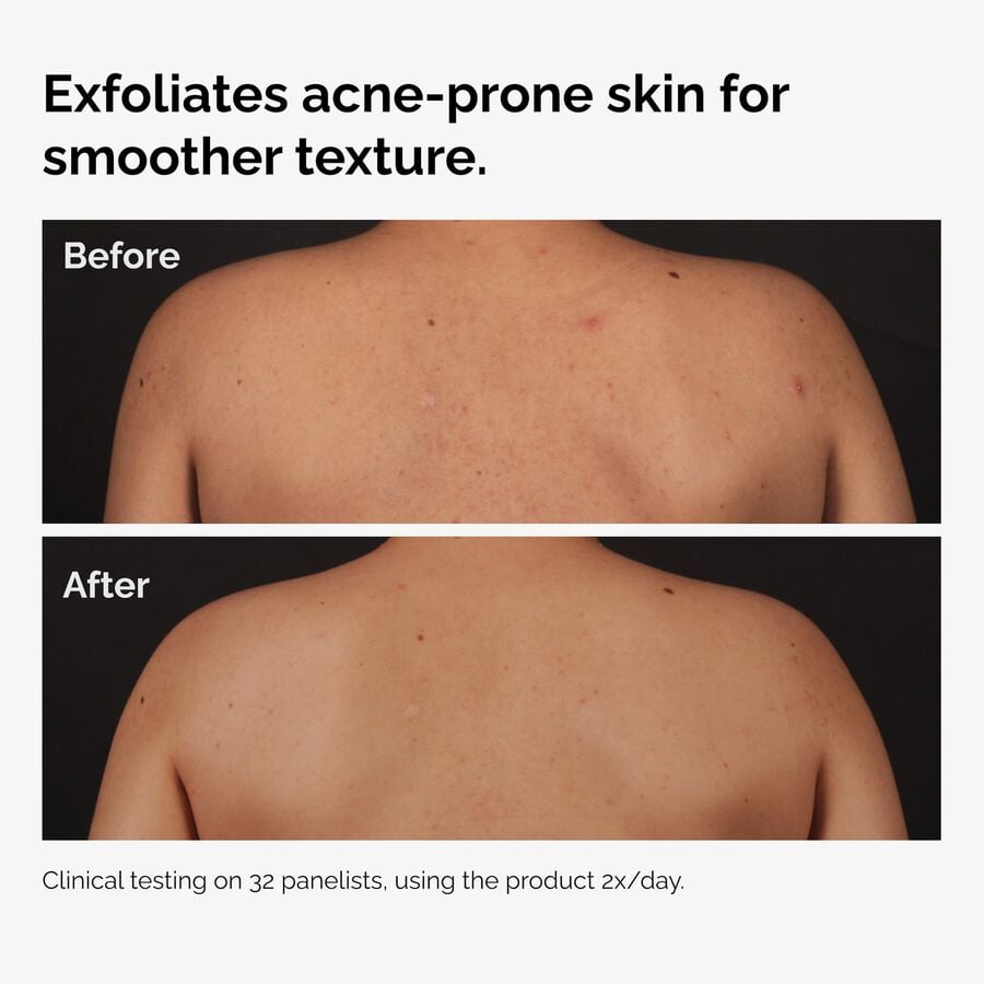 the-body-care-collection-a3 ord-salicylic-acid-body-serum-before-after-graphic-NA.jpg