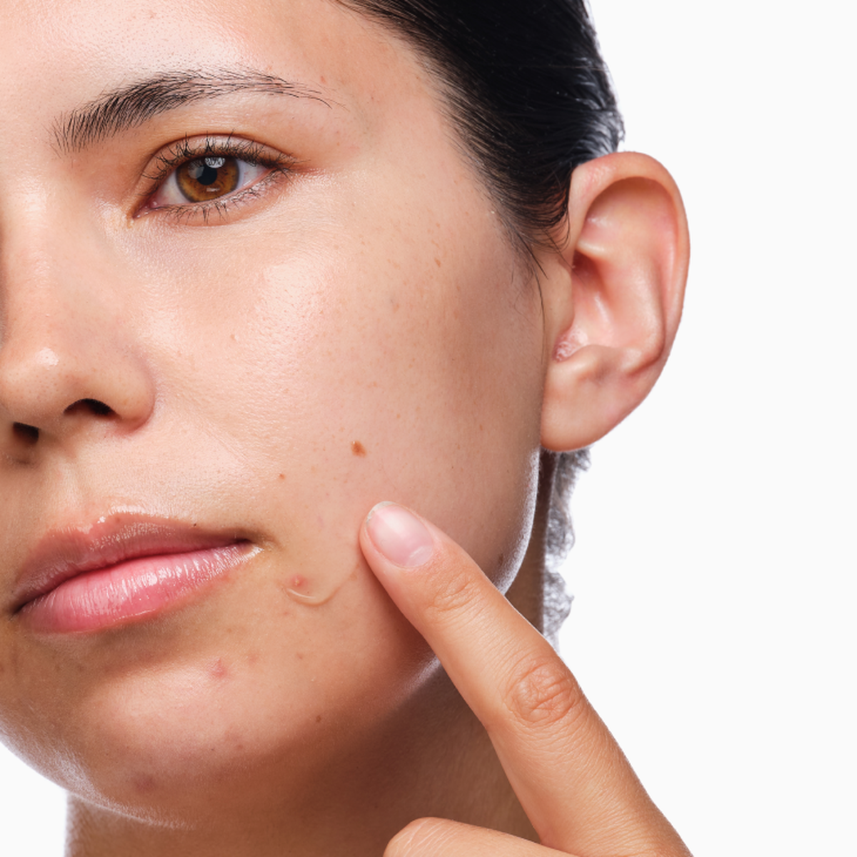 the-acne-set-v2 rdn-the-acne-set-application.png
